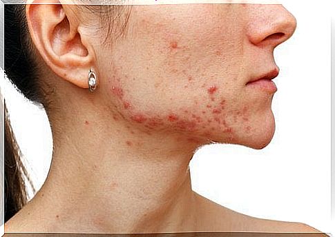 fight acne