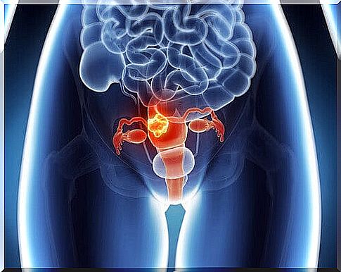 6 symptoms of cervical cancer you should know about