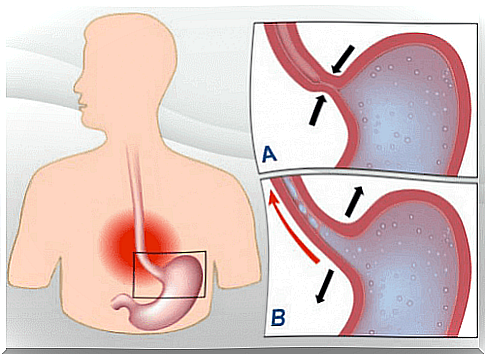 7 natural remedies to treat acid reflux