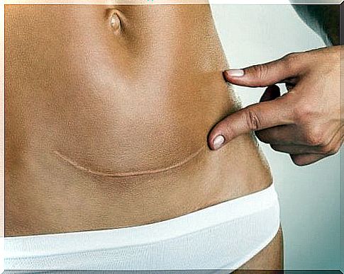 Woman with scars on her stomach