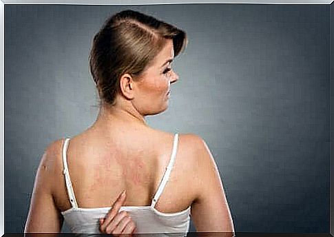 Woman with rash on her back