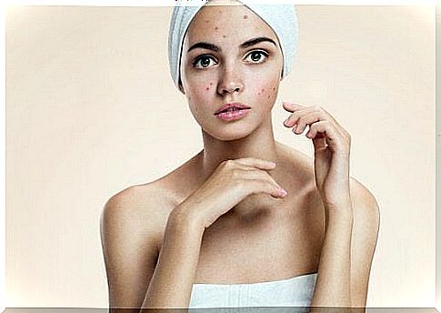 Get a healthy, clean and acne-free face