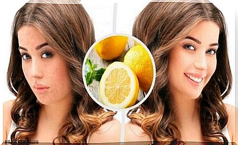 Four natural home remedies to eliminate acne scars