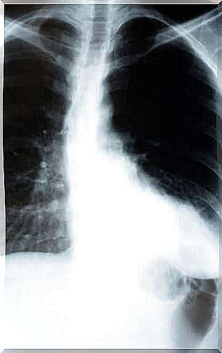 Learn how the body is affected by pneumonia