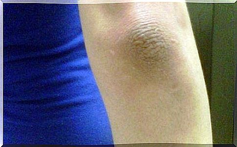 Natural remedies for discolored elbows and knees