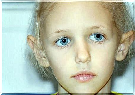 Children with retinoblastoma