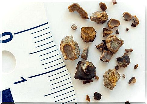 kidney stone