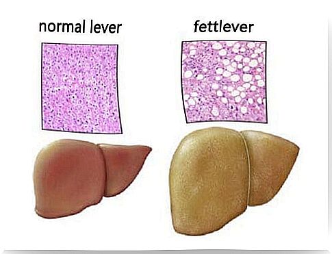 fatty liver