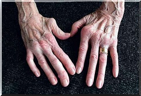 The hands of an elderly woman with arthritis.