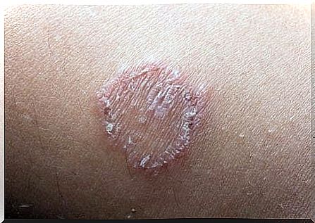 What is ringworm and how do we treat it?