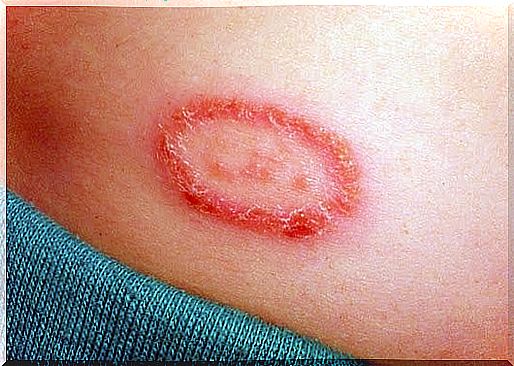 What is ringworm?